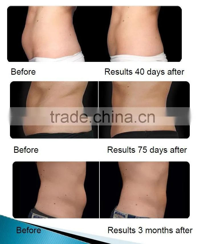 CE / FDA approved beauty device velashape cavitation RF body shaping machine