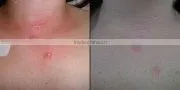 Newest !!! luxury fractional co2 laser acne scar removal