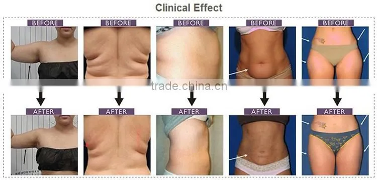 vacuum roller 650nm lipo laser liposuction fat reduction machine without surgery