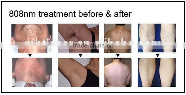 2016 Hottest 808nm diode laser, portable laser hair removal, 808nm diode laser hair removal machine for sales