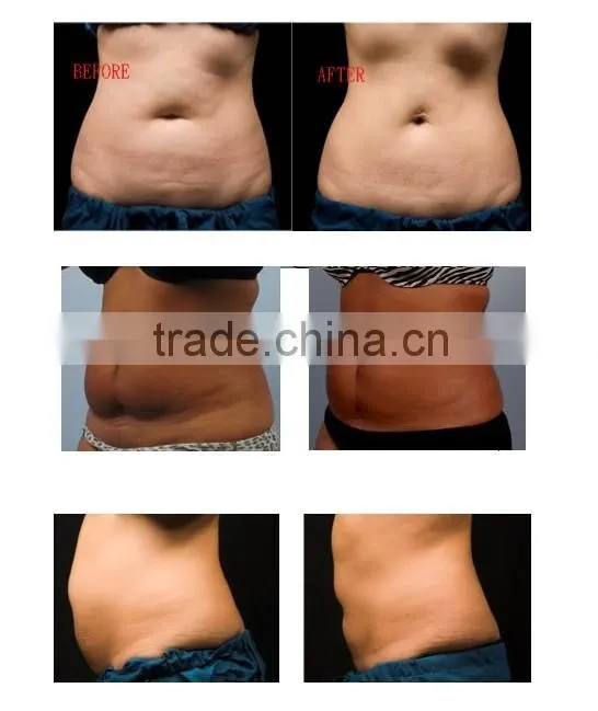 GS86 Professional ultrasonic cavitation machine with laser