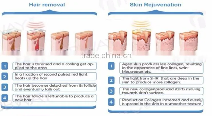 CE Certificated permanent hair removal SHR OPT IPL permanent hair removal laser in alibaba