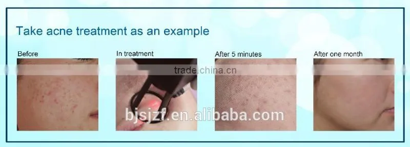 F5 Portable Style Fractional home laser scar removal fractional co2 laser