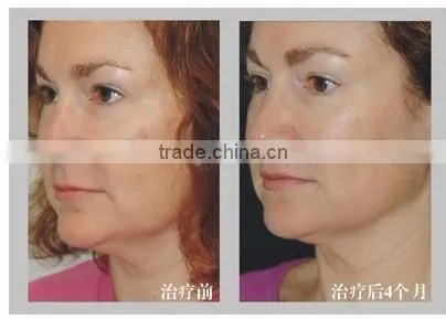 China new Multifunction Bio Oxy Skin jet water oxygene peel