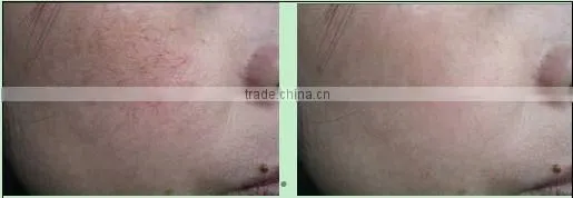 Promotion! most advanced spider vein