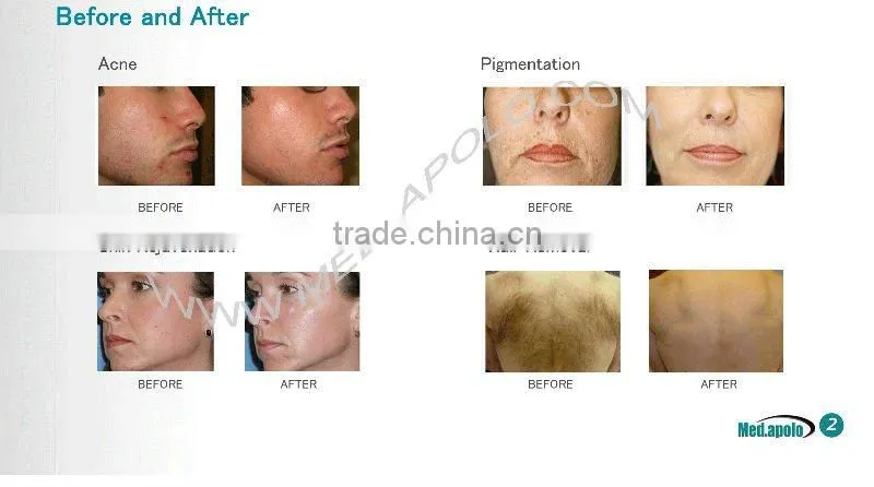 Med.apolo HS-665 Elight(IPL + RF) laser hair removal beauty machine