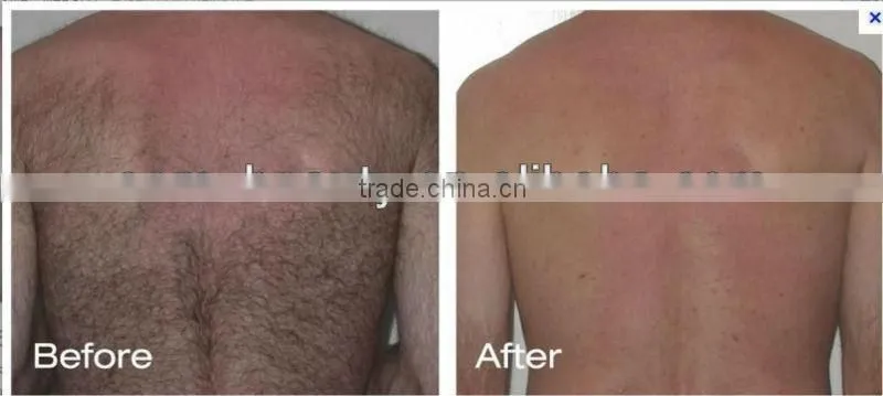 Hight quality IPL beauty machine A003 at Low price