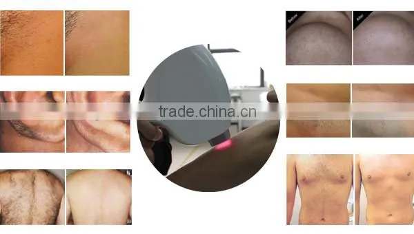 Pain Free 808nm Laser Diode Epil Unwanted Hair Removal Laster Treatment Laser Depilator