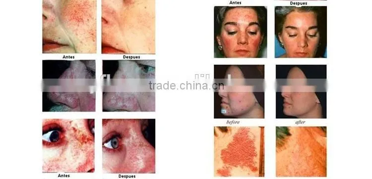 Best choice Face LED PDT led pdt bio-light therapy 7 color lights pdt machine in usa