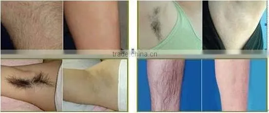 808nm diode laser hair removal machine women underarm hair removal machine