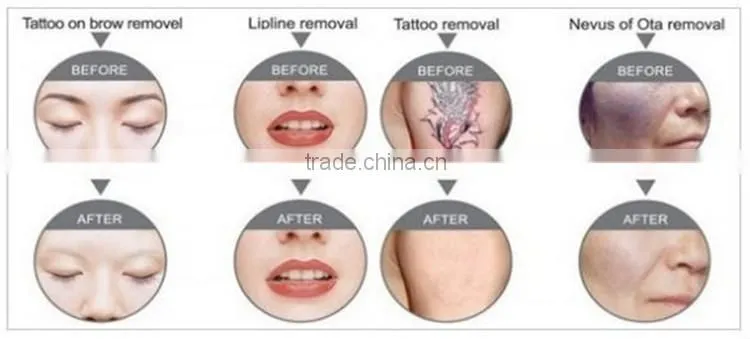 High quality professional Q switch nd yag tattoo removal laser machine