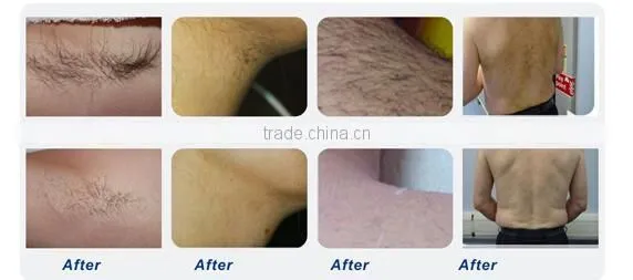 Good quality new technology fast permanent ipl shr hair removal machine