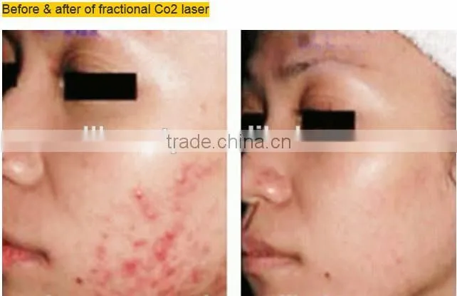 CO2 fractional beauty for facial resurfacing machine