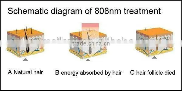 808nm Diode Laser Hair Removal Machine For Women , Laser Treatment For Facial Hair