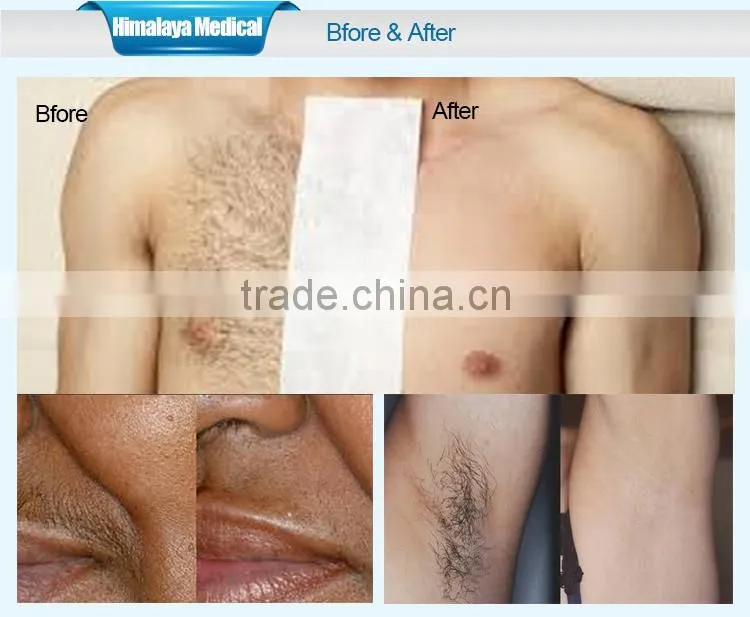 Best beauty machine hair removal diode laser machine 808nm