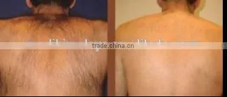 New design best price aesthetic diode laser machine for hair removal