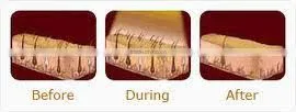 Good Effect!Ipl Shr Laser Machine/Ipl Shr Laser ForHair Removal and Skin tightening