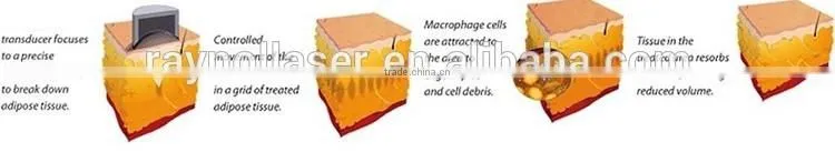 Ultrashape HIFU Body Slimming Cosmetic Hifu Slimming Device