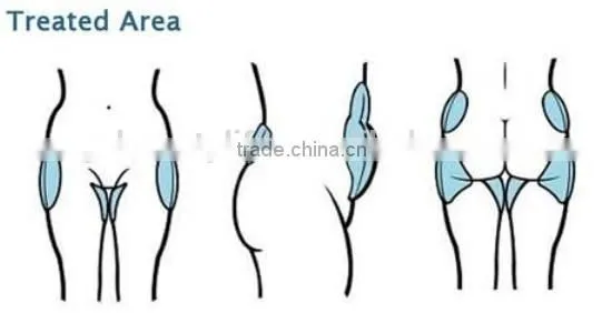 smart Cryolipolysis fat freeze machine for home use