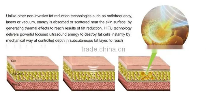 liposonix machine hifu body liposonix slimming machine lipo laser weight loss machine liposonix
