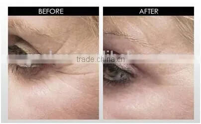180 needles micro needle roller eye treatment derma roller
