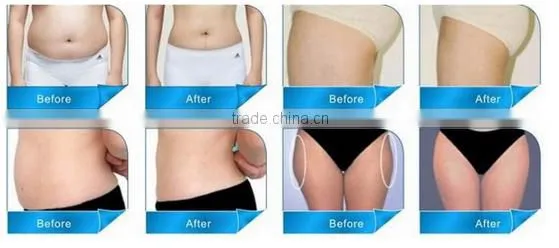 3D positioning weight loss lipo hifu equipment