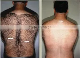 facial and body hair removal nd yag laser hair removal machine