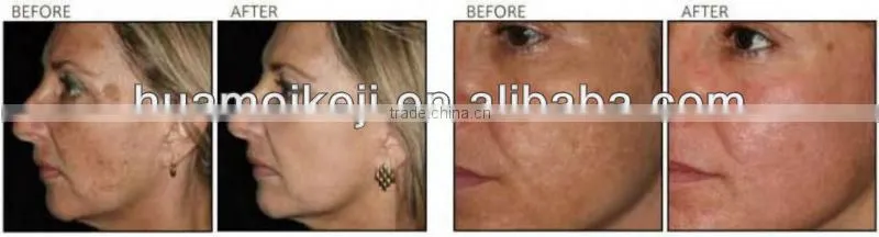 popular co2 fractional laser system