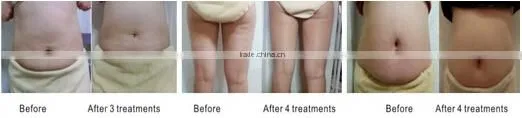 HIFUSHAPE nubway hifu for body slimming fat loss hifu equipment