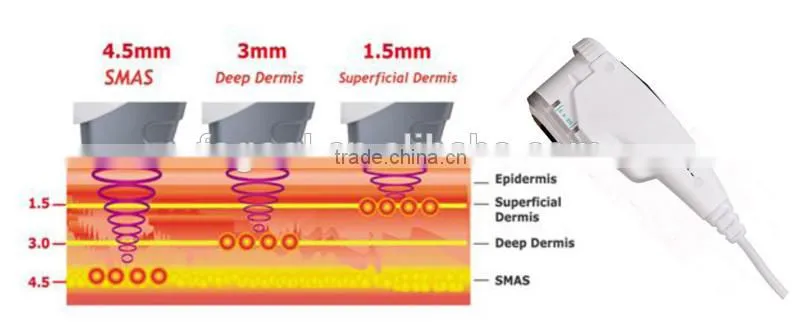 Portable Ultrasound Machine High Quality HIFU Face Lift