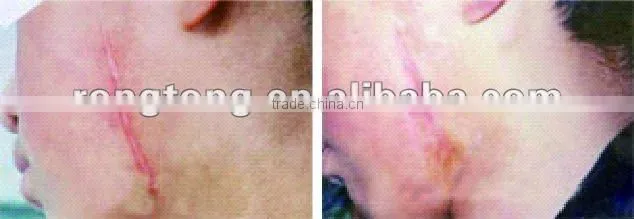 MED-870+ Laser Vertical co2 fractional laser beauty machine