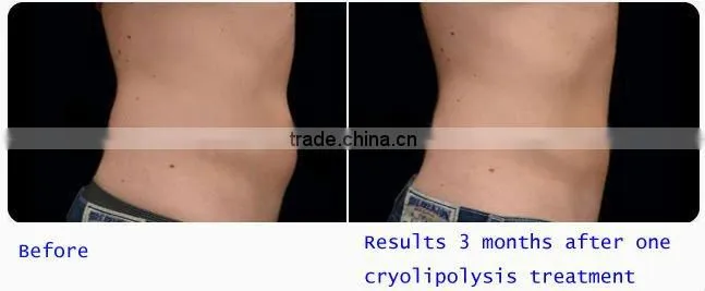 best cool slimming machine