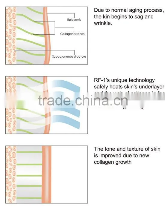 NL-RUV900 TOP SELLER!!! vertical rf laster Body reshaping weight loss and remove wrinkle machine with CE