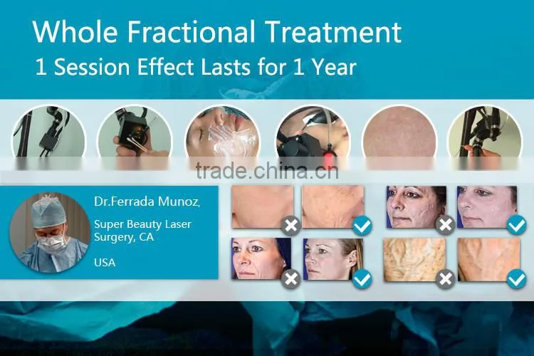 2015 CO2 Fractional portable co2 fractional laser