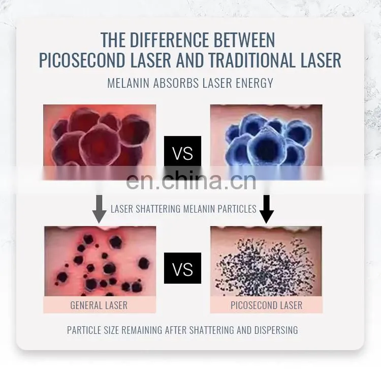 Professional Brown Style Pico Laser Tattoo Removal Solon Beauty Machine