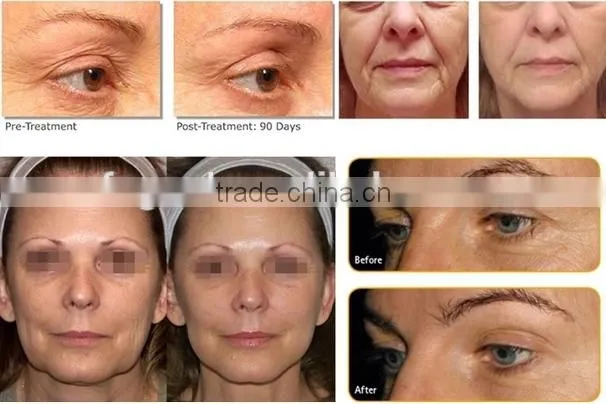 High Quality Hifu non surgical face lift Ultrasound Skin Tightening machine