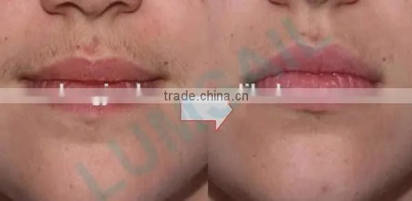 shr opt ipl diode laser permanent hair removal wholesale laser hair removal