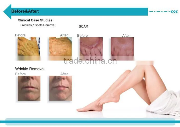 portable RF drive fractional freckle wrinkle acne scar removal whiting CO2 fractional laser machine -CV-II
