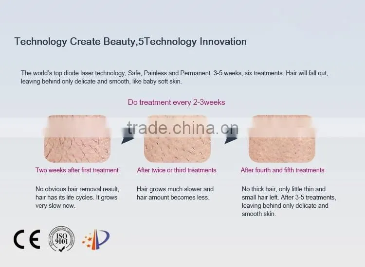 High Power 808nm diode laser permanent hair removal machine