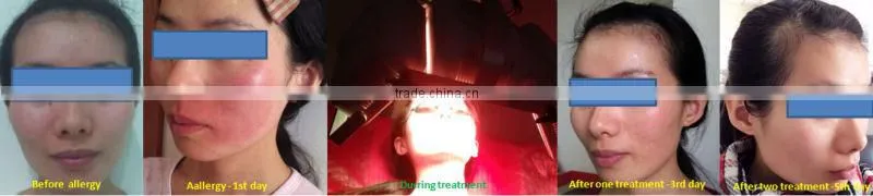 Apolomed professional LED facial treatment/ led light therapy for skin