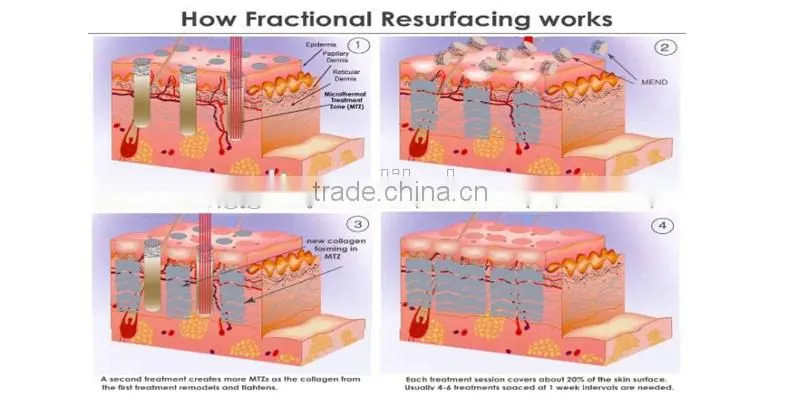 New technology fractional co2 laser scar removal, fractional co2 vagina rejuvenation laser