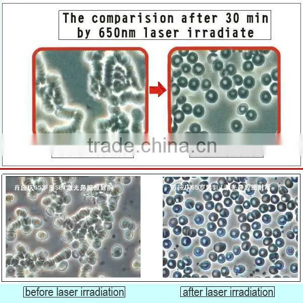 cold lipo cold laser therapy equipment hand held cold laser