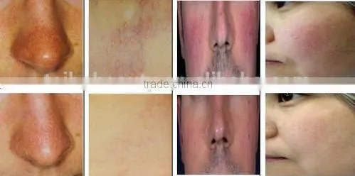 High frequency Vascular remvoal machine/Beauty salon used vascular remvoal device for sale