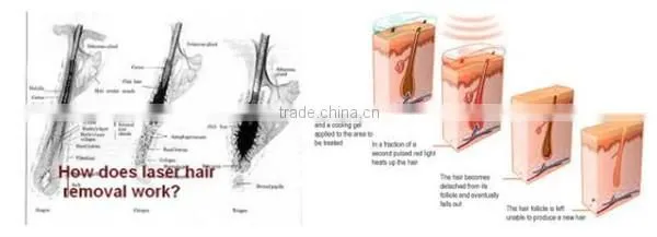 Latest Germany device 808 diode / nd yag hair removal laser
