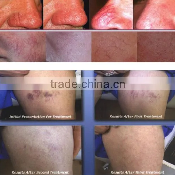 Best 980nm varicose veins laser treatment machine / skin care / medical laser treatment equipment