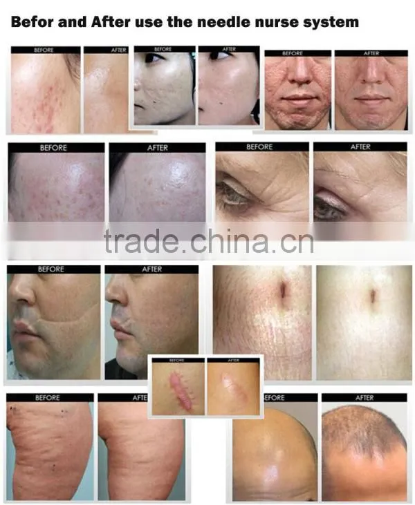 DRS microneedling dermaroller 540 hair loss treatment micro needle roller home use titanium 540 derma roller L015