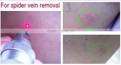 Cooling system 1mm-12mm laser depilation for hair removal,nail fungus laser --P001