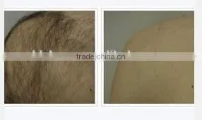 Wanted Distributor permanent hair removal for men machine home use