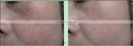 Promotion! most advanced spider vein