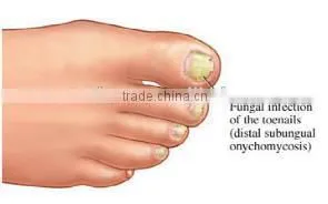Nail Fungus Treatment laser